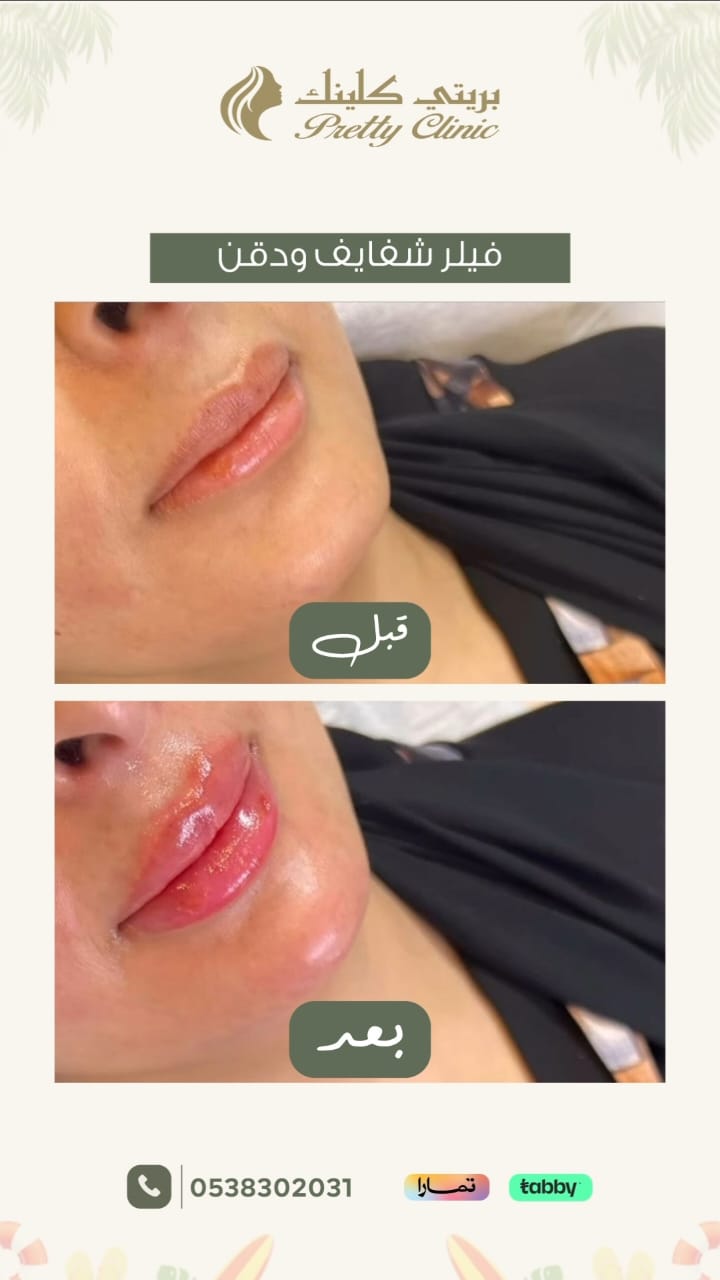 فيلر شفايف ودقن